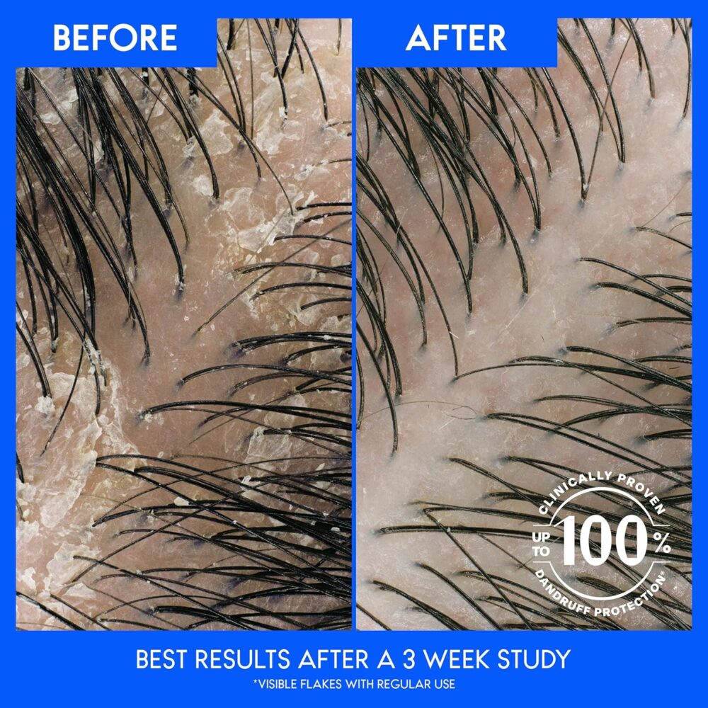 Head and Shoulders Shampoo and Conditioner 2 in 1, Anti Dandruff Treatment - Image 2